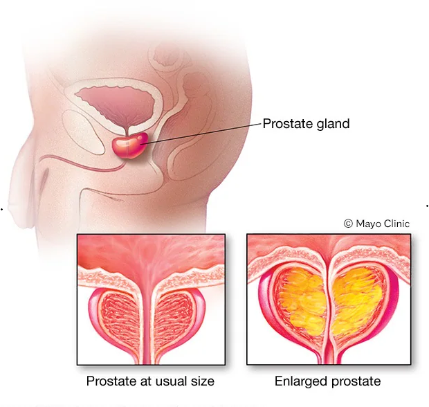 Prostate Health